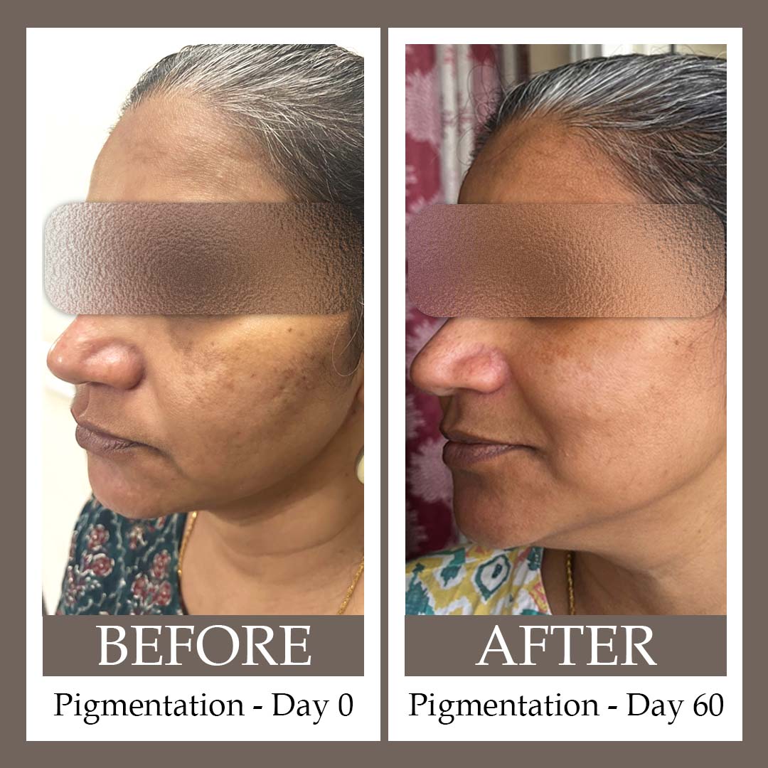Block Pigmentation Thumbnail